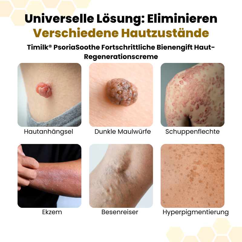 Timilk® PsoriaSoothe Fortschrittliche Bienengift Haut-Regenerationscreme